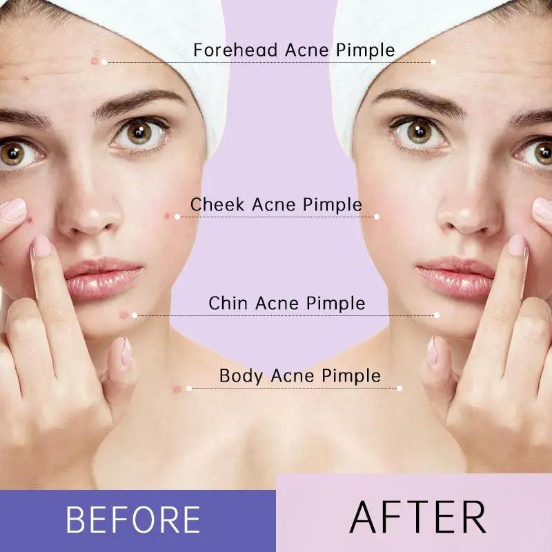 (BUY 1 GET 2) AUQUEST - Invisible Zit Patch