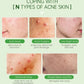 TEA TREE - Serum Acne Removal